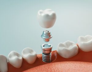 dental implants in Greenville, TX